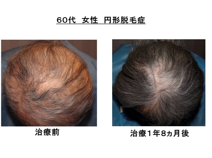 円形脱毛症　病院